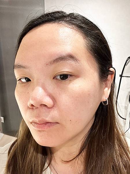 【醫美】除斑細緻毛孔推薦～台北愛爾麗診所分享-蜂巢皮秒心得分