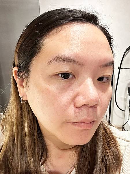 【醫美】除斑細緻毛孔推薦～台北愛爾麗診所分享-蜂巢皮秒心得分