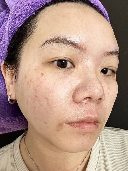 【醫美】除斑細緻毛孔推薦～台北愛爾麗診所分享-蜂巢皮秒心得分