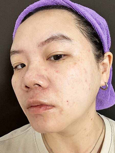 【醫美】除斑細緻毛孔推薦～台北愛爾麗診所分享-蜂巢皮秒心得分