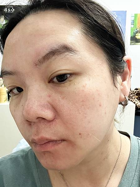 【醫美】除斑細緻毛孔推薦～台北愛爾麗診所分享-蜂巢皮秒心得分