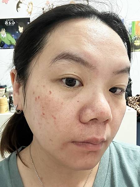 【醫美】除斑細緻毛孔推薦～台北愛爾麗診所分享-蜂巢皮秒心得分