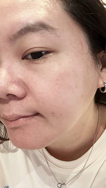 【醫美】除斑細緻毛孔推薦～台北愛爾麗診所分享-蜂巢皮秒心得分