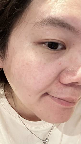 【醫美】除斑細緻毛孔推薦～台北愛爾麗診所分享-蜂巢皮秒心得分