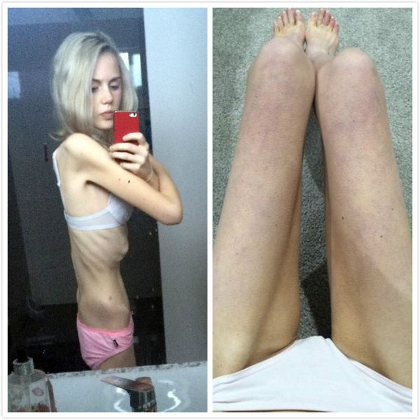 澳洲一名患厭食症的「美少女」瘦到35公斤，甚至曾一星期不吃不喝，差點喪命...現在的她是這樣!!!2