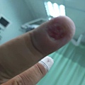 thumb