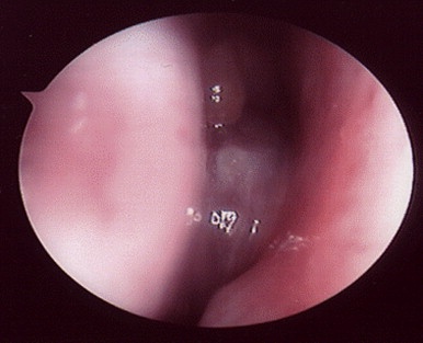 nasalpolyps_allergy