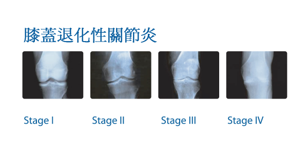 stages-of-knee