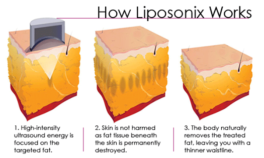Liposonix work.png
