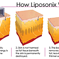 Liposonix work.png