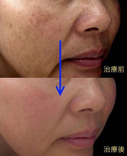 肝斑 Melasma 小沙吉醫師的部落格 痞客邦