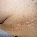 ACANTHOSIS.jpg