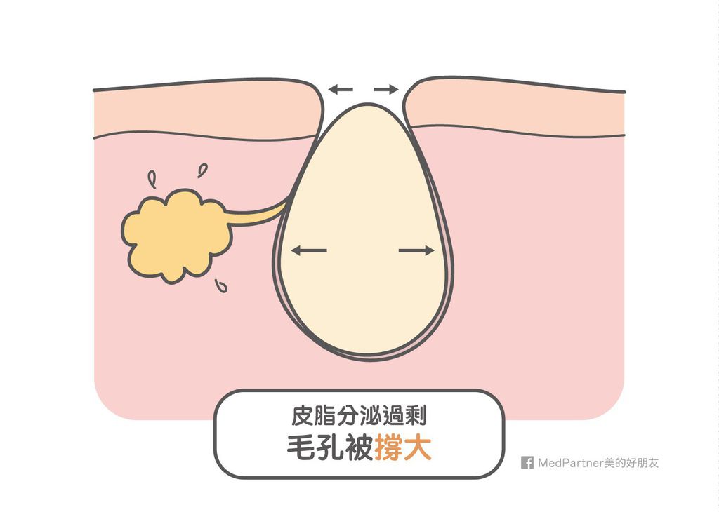 粉刺_毛孔被撐大.jpg