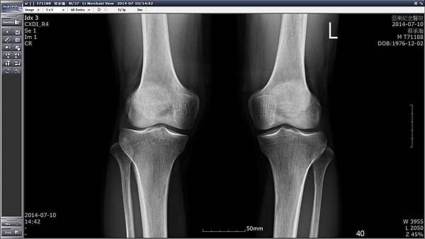亞東_兩腳膝蓋X光照片_直立從正面站內八拍的.jpg