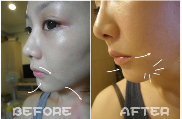 玻尿酸除皺 星采古亭醫美 楊志雄醫師 垂垂嘴角掰掰 給我有精神的微笑線吧 大力 星采星和醫美