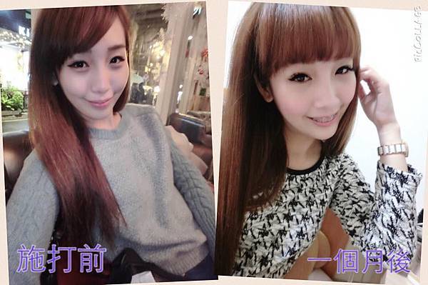 星和高雄_Ultherapy極線音波拉提_泡菜菜ㄦ11