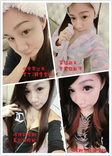 台中醫美星和診所_杏仁酸煥膚_布小丁、Demi Wei、尹蓁01