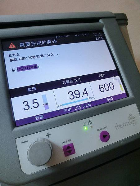 星采大安_Ultherapy極線音波拉提+電波拉皮+玻尿酸填補額頭+淚溝+蘋果肌_阿眯頭16 星采大安_Ultherapy極線音波拉提+電波拉皮+玻尿酸填補額頭+淚溝+蘋果肌_阿眯頭16
