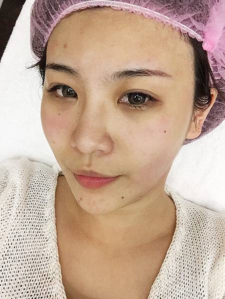 星采大安_Ultherapy極線音波拉提+電波拉皮+玻尿酸填補額頭+淚溝+蘋果肌_阿眯頭13 星采大安_Ultherapy極線音波拉提+電波拉皮+玻尿酸填補額頭+淚溝+蘋果肌_阿眯頭13