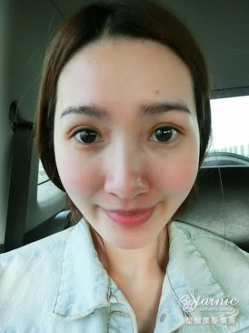 星和高雄_雙眼皮(縫)_賴衍翰院長06 星和高雄_雙眼皮(縫)_賴衍翰院長06