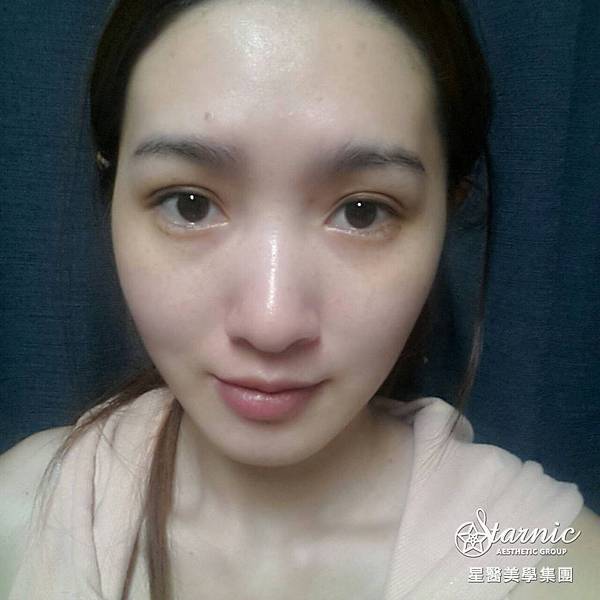 星和高雄_雙眼皮（縫）_賴衍翰院長11