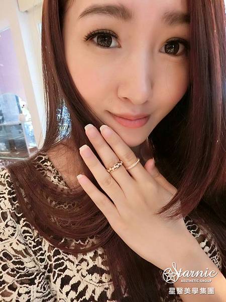 星和高雄_雙眼皮(縫)_賴衍翰院長13 星和高雄_雙眼皮(縫)_賴衍翰院長13