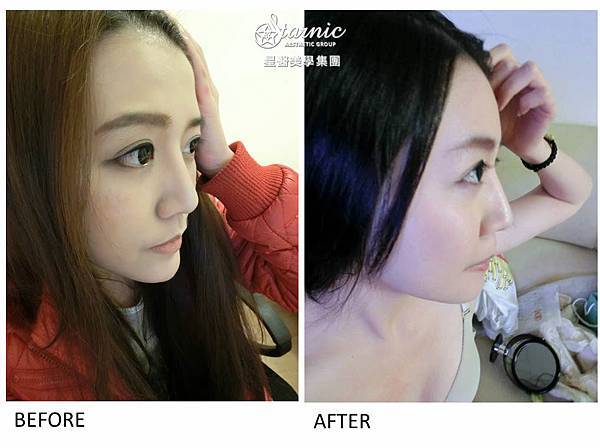 星和台中_自體脂肪填補_張巧芸01 星和台中_自體脂肪填補_張巧芸01