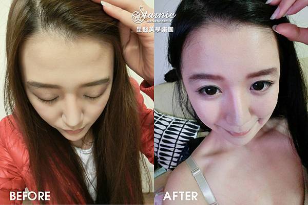 星和台中_自體脂肪填補_張巧芸02 星和台中_自體脂肪填補_張巧芸02