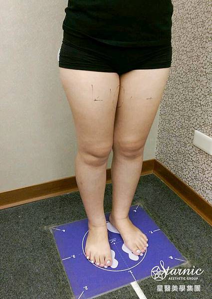 星和台中_歐萃學超音波系統(標靶震波)_Mika13 星和台中_歐萃學超音波系統(標靶震波)_Mika13