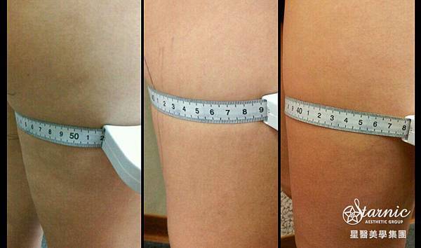 星和台中_歐萃學超音波系統(標靶震波)_Mika19 星和台中_歐萃學超音波系統(標靶震波)_Mika19