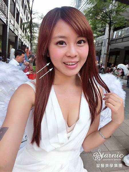 星和仁愛_Ulthera極線音波拉提_耶比02 星和仁愛_Ulthera極線音波拉提_耶比02