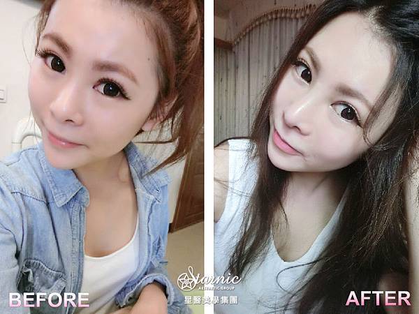 星采大安_卡麥拉三段式隆鼻+敲鼻骨+耳軟骨_邱大睿醫師01 星采大安_卡麥拉三段式隆鼻+敲鼻骨+耳軟骨_邱大睿醫師01