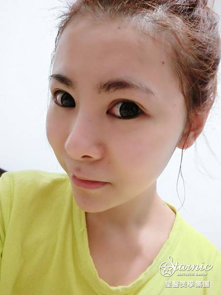 星采大安_卡麥拉三段式隆鼻+敲鼻骨+耳軟骨_邱大睿醫師04 星采大安_卡麥拉三段式隆鼻+敲鼻骨+耳軟骨_邱大睿醫師04