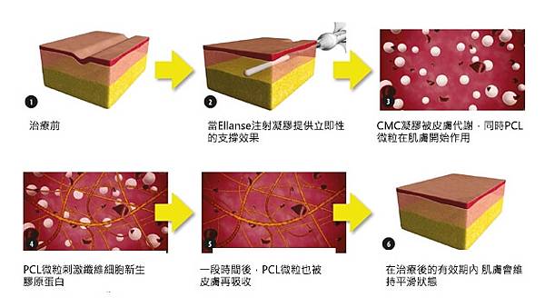 Ellanse洢蓮絲（又名依戀詩，市場俗稱少女針）作用原理