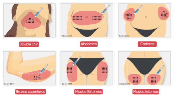 皮下燃脂（俗稱消脂針）可施打部位