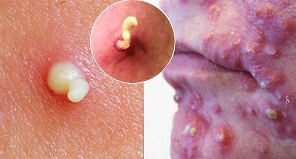 Acne05.jpg Acne05.jpg