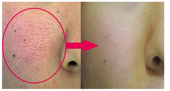 Pores2.png Pores2.png