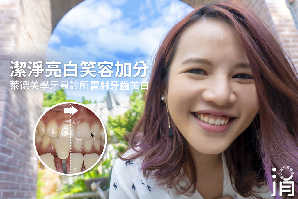 潔淨亮白笑容加分－溫馨舒適的雷射牙齒美白療程心得分享