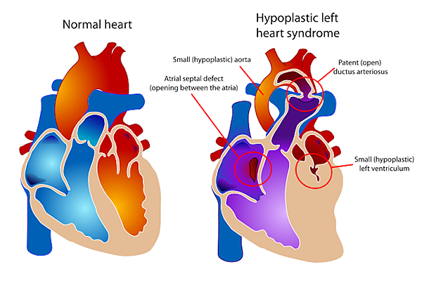 HLHS-and-Normal-Heart.png