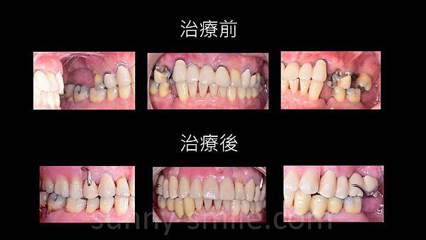 東湖全口重建/牙周病治療