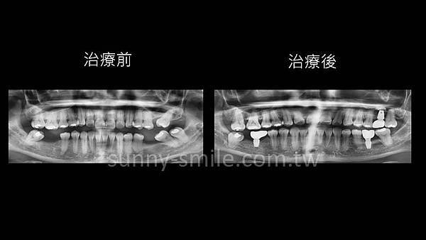 內湖東湖全口重建/植牙/矯正治療