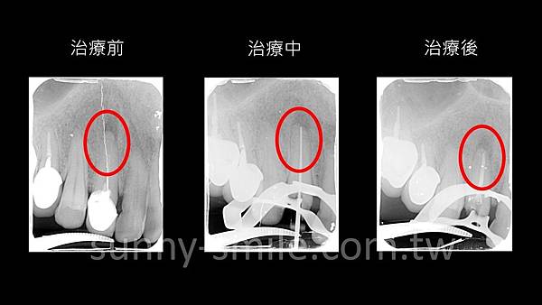 內湖東湖顯微根管/抽神經