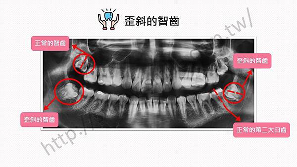 歪斜的智齒該不該拔？！