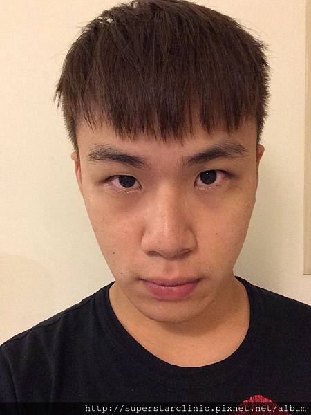 雙眼皮術後 雙眼皮術後