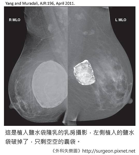 鹽水袋破掉了