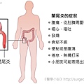 闌尾炎的症狀