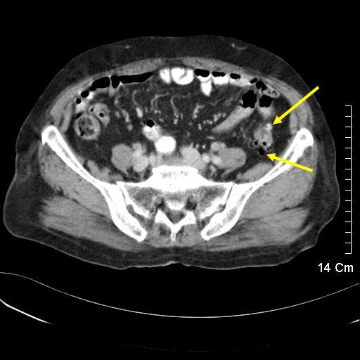 01 diverticulum.jpg