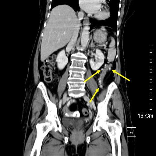 02 diverticulum.jpg