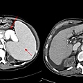 05 portal hypertension.jpg