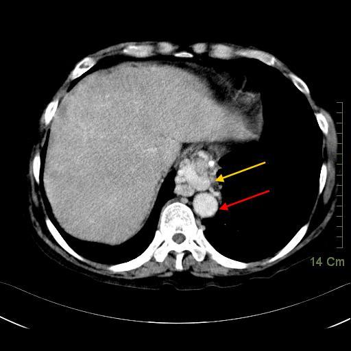 06 esophageal varices.jpg